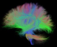 White Matter Tractography of the Human Brain in Sagittal View