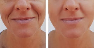 Woman wrinkles on face dermatology before and after health anti-aging procedures