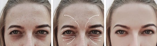 Woman wrinkles swollen effect biorevitalization face before and after procedures, correction stock images Woman wrinkles swollen effect biorevitalization face before and after procedures, correction stock images