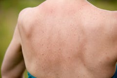 Women with skin pigmentation on back Royalty Free Stock Images Women with skin pigmentation on back Royalty Free Stock Images