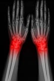 X-ray hand of man with arthritis stock illustration X-ray hand of man with arthritis stock illustration