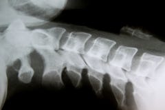 X-Ray image of healthy regular cervical spine negative results royalty free stock images X-Ray image of healthy regular cervical spine negative results royalty free stock images