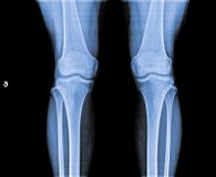 X Ray of Knee joint. royalty free stock images X Ray of Knee joint. royalty free stock images