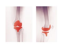 X-ray Of A Knee Replacement Stock Images X-ray Of A Knee Replacement Stock Images