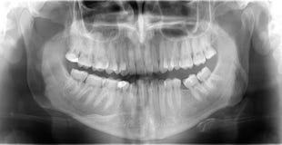 X-ray teeth stock image X-ray teeth stock image