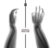 X-ray of the wrist. Greenstick fracture of the radius. Marker. Negative. stock image X-ray of the wrist. Greenstick fracture of the radius. Marker. Negative. stock image