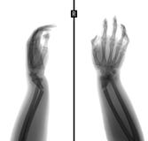 X-ray of the wrist. Greenstick fracture of the radius. Negative. stock images X-ray of the wrist. Greenstick fracture of the radius. Negative. stock images