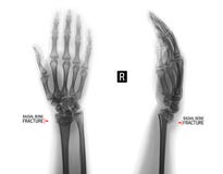 X-ray of the wrist joint. Fracture of the radius. Negative. Marker. stock photography X-ray of the wrist joint. Fracture of the radius. Negative. Marker. stock photography