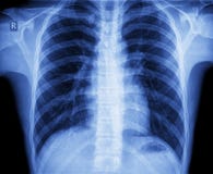 Xray chest stock photo Xray chest stock photo