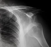 Sport injury- Plain film X-ray, radiography of dislocated shoulder