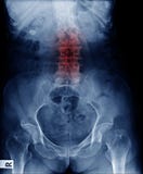 Lumbar spondylosis x-ray image stock photo Lumbar spondylosis x-ray image stock photo