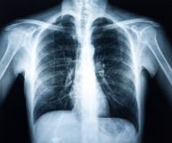 Xray ludzki torax fotografia stock Xray ludzki torax fotografia stock