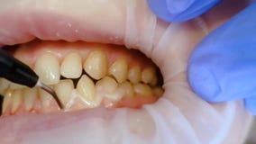 Liquid cofferdam, photopolymer, is applied to teeth during whitening