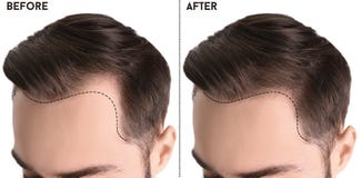 Young man before and after hair loss treatment against white background