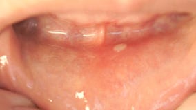 Zakończenie stomatitis w usta zbiory wideo Zakończenie stomatitis w usta zbiory wideo