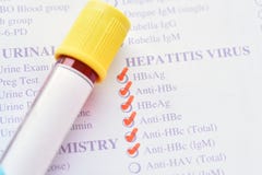 Zapalenie Wątroby B wirusa test zdjęcie stock Zapalenie Wątroby B wirusa test zdjęcie stock
