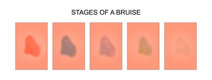 Étapes de la guérison d'une contusion illustration de vecteur Étapes de la guérison d'une contusion illustration de vecteur
