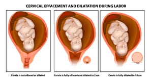 Αυχενικές effacement και θερμική μεταβολή διαστάσεων διανυσματική απεικόνιση Αυχενικές effacement και θερμική μεταβολή διαστάσεων διανυσματική απεικόνιση
