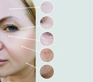 Женские морщинки перед и после коллажем процедурам по терапией beautician регенерации разницы зрелым стоковое изображение Женские морщинки перед и после коллажем процедурам по терапией beautician регенерации разницы зрелым стоковое изображение