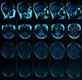 Магниторезонансная развертка мозга с черепом Развертка головы MRI на цвете темной предпосылки голубом стоковые изображения rf Магниторезонансная развертка мозга с черепом Развертка головы MRI на цвете темной предпосылки голубом стоковые изображения rf
