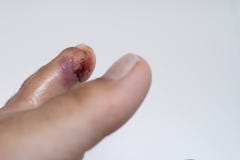 Палец на ноге Гнойная рана на ноге eczema дерматит Псориаз стоковые изображения Палец на ноге Гнойная рана на ноге eczema дерматит Псориаз стоковые изображения