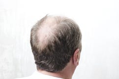 Łysy plecy mężczyźni kierowniczy Pojęcie baldness obrazy stock Łysy plecy mężczyźni kierowniczy Pojęcie baldness obrazy stock