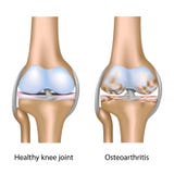 łączny kolanowy osteoarthritis ilustracji łączny kolanowy osteoarthritis ilustracji