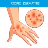 Έκτοπα dermatis Το πρόσωπο γρατσουνίζει το βραχίονα στον οποίο είναι έκτοπη δερματίτιδα itching ελεύθερη απεικόνιση δικαιώματος Έκτοπα dermatis Το πρόσωπο γρατσουνίζει το βραχίονα στον οποίο είναι έκτοπη δερματίτιδα itching ελεύθερη απεικόνιση δικαιώματος