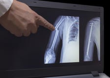 Ακτίνα X του σπασίματος ενός χεριού και του χεριού μετά από τη λειτουργία στοκ εικόνες Ακτίνα X του σπασίματος ενός χεριού και του χεριού μετά από τη λειτουργία στοκ εικόνες