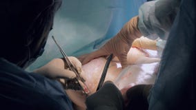 Επαγγελματικός χειρούργος που εκτελεί μια εμφύτευση μοσχευμάτων στους αποστειρωμένους όρους απόθεμα βίντεο Επαγγελματικός χειρούργος που εκτελεί μια εμφύτευση μοσχευμάτων στους αποστειρωμένους όρους απόθεμα βίντεο