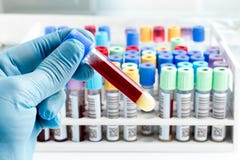 Εργαστηριακός τεχνικός που κρατά μια δοκιμή σωλήνων αίματος Εργαστηριακός τεχνικός που κρατά μια δοκιμή σωλήνων αίματος