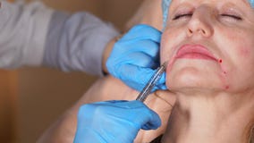 Κλείστε αυξημένος της διαδικασίας Botox στις ομαλές έξω του προσώπου ρυτίδες απόθεμα βίντεο Κλείστε αυξημένος της διαδικασίας Botox στις ομαλές έξω του προσώπου ρυτίδες απόθεμα βίντεο