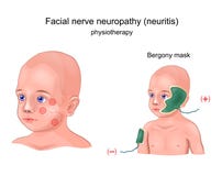 Μάσκα Bergony φυσιοθεραπείας απεικόνιση αποθεμάτων Μάσκα Bergony φυσιοθεραπείας απεικόνιση αποθεμάτων