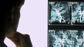 Νευρολόγος γυναικών που εξετάζει την ακτίνα X των αιμοφόρων αγγείων, αγγειακό κλείσιμο, επεξεργασία απόθεμα βίντεο Νευρολόγος γυναικών που εξετάζει την ακτίνα X των αιμοφόρων αγγείων, αγγειακό κλείσιμο, επεξεργασία απόθεμα βίντεο