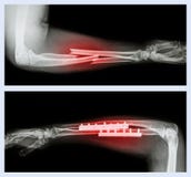 Верхнее изображение: Сломайте ulnar и радиус (косточка) предплечья, более низкое изображение: Оно эксплуатировался и внутреннее ф стоковое фото Верхнее изображение: Сломайте ulnar и радиус (косточка) предплечья, более низкое изображение: Оно эксплуатировался и внутреннее ф стоковое фото