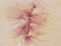 Взрез от поясничной хирургии Laminenectomy покрытой с Derma-bo Стоковая Фотография RF Взрез от поясничной хирургии Laminenectomy покрытой с Derma-bo Стоковая Фотография RF