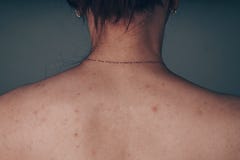 Женщины представляя рядом с старой черной текстурированной стеной худенькое тело подростка, покрытое с молями и цыпками проблемны стоковые изображения Женщины представляя рядом с старой черной текстурированной стеной худенькое тело подростка, покрытое с молями и цыпками проблемны стоковые изображения