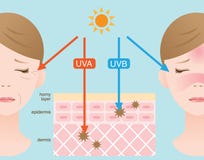 Иллюстрация кожи Infographic Разница между UVA и UVB излучает проникание иллюстрация вектора Иллюстрация кожи Infographic Разница между UVA и UVB излучает проникание иллюстрация вектора