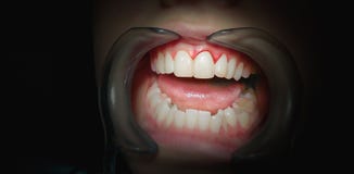 Изреките с камедями кровотечения на темной предпосылке стоковое фото Изреките с камедями кровотечения на темной предпосылке стоковое фото