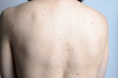 Кожа на задней части женщины с молями Стоковая Фотография Кожа на задней части женщины с молями Стоковая Фотография