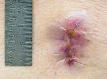 Конец-вверх поясничных взреза и правителя Lamimenectomy показывая его Стоковое Изображение RF Конец-вверх поясничных взреза и правителя Lamimenectomy показывая его Стоковое Изображение RF