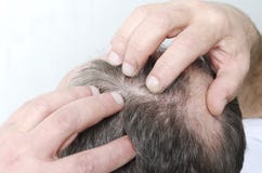 Крупный план лысой головы людей Человек cheking его волосяный покров отступать стоковое изображение Крупный план лысой головы людей Человек cheking его волосяный покров отступать стоковое изображение