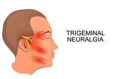 Невралгия Trigeminal нейронаука иллюстрация штока Невралгия Trigeminal нейронаука иллюстрация штока