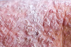 ОБЪЯВЛЕНИЕ атопического дерматита, также известное как атопический eczema, тип воспаления дерматита кожи стоковые изображения rf ОБЪЯВЛЕНИЕ атопического дерматита, также известное как атопический eczema, тип воспаления дерматита кожи стоковые изображения rf