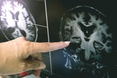 ОБЪЯВЛЕНИЕ с изменением белого вещества CVD стоковые фото ОБЪЯВЛЕНИЕ с изменением белого вещества CVD стоковые фото