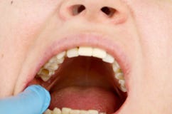 Отверстие в зубе и обработка зубоврачебных каналов Обработка periodontitis в зубоврачебной клинике стоковые изображения Отверстие в зубе и обработка зубоврачебных каналов Обработка periodontitis в зубоврачебной клинике стоковые изображения