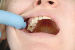 Отверстие в зубе и обработка зубоврачебных каналов Обработка periodontitis в зубоврачебной клинике стоковые изображения Отверстие в зубе и обработка зубоврачебных каналов Обработка periodontitis в зубоврачебной клинике стоковые изображения