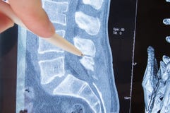 Патология позвоночника фото MRI lumbosacral Радиолог показанный на возможных патологии или заболевании изображения позвоночника l стоковая фотография Патология позвоночника фото MRI lumbosacral Радиолог показанный на возможных патологии или заболевании изображения позвоночника l стоковая фотография