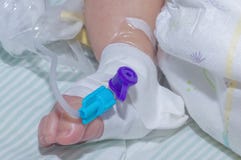 Периферийный внутривенный катетер в вене newborn ноги младенца стоковые фото Периферийный внутривенный катетер в вене newborn ноги младенца стоковые фото
