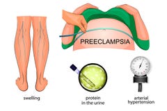 Симптомы eclampsia в беременности иллюстрация штока Симптомы eclampsia в беременности иллюстрация штока